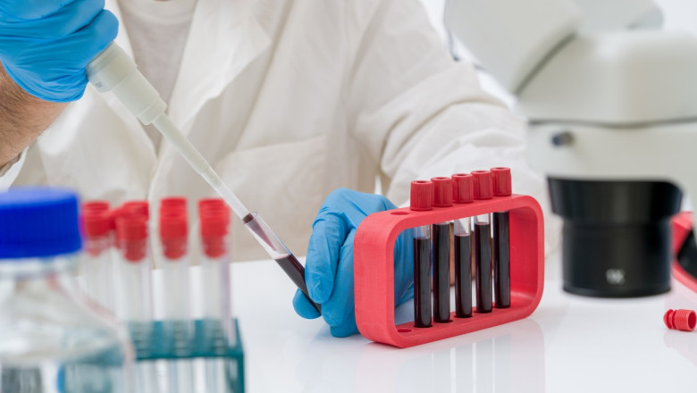 Un simplu test de sânge ar putea identifica mutațiile canceroase cu trei ani înainte de manifestarea simptomelor, potrivit unei cercetări recente. 1 un test de sange ar putea detecta prezenta mutatiilor maligne cu 3 ani inainte de aparitia primelor simptome de cancer arata un studiu 6864b609005b6