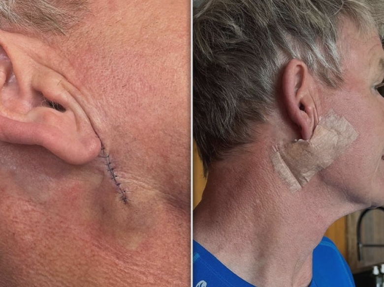 Gordon Ramsay trece printr-un tratament pentru îndepărtarea cancerului de piele și își dezvăluie cicatricea de la intervenție 1 gordon ramsay gets treatment to remove skin cancer shows surgery scar 68b325ad18e3a