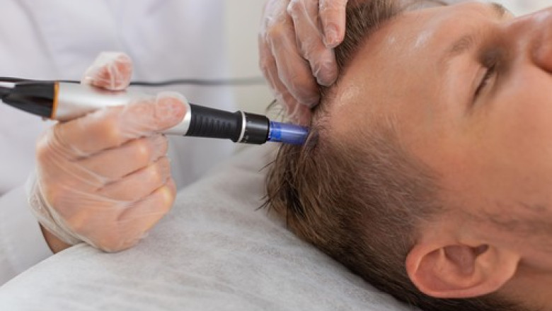 Un bărbat de 38 de ani și-a pierdut viața în urma unei intervenții de transplant de păr în Turcia 1 un barbat in varsta de 38 de ani a murit in timpul unei proceduri de transplant de par in turcia 688f972bbefdc