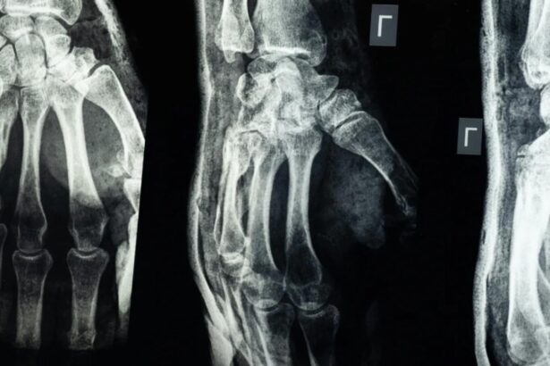 a fost descoperit adezivul care lipeste oasele in doar doua minute lipiciul promite sa schimbe ortopedia din temelii 68cbc9e48e6b8