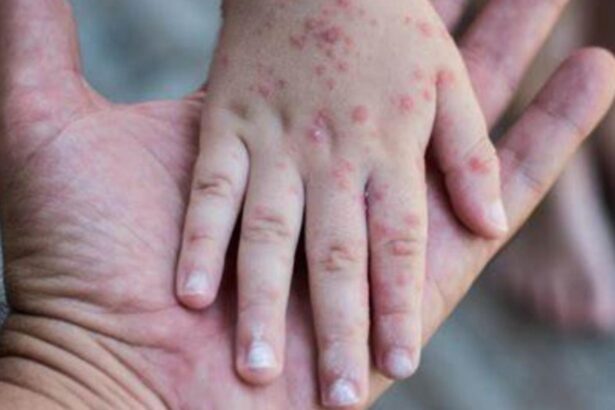 caz neasteptat un copil a murit la cativa ani dupa ce s a vindecat de rujeola afectiunea sspe care i a adus sfarsitul 68cbb26842a24