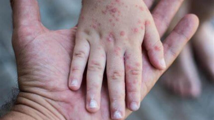 Tragedie surprinzătoare: un copil a decedat la câțiva ani după ce a învins rujeola, din cauza afecțiunii SSPE care l-a răpus 1 caz neasteptat un copil a murit la cativa ani dupa ce s a vindecat de rujeola afectiunea sspe care i a adus sfarsitul 68cbb26842a24