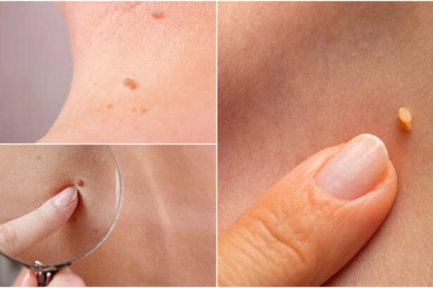 ce sunt papiloamele si cat de periculoase pot fi iata cum poti scapa de ele 68c9b3a89c441