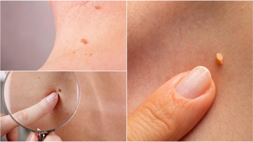 Papiloamele: Ce trebuie să știi despre ele și metodele de îndepărtare a acestora 1 ce sunt papiloamele si cat de periculoase pot fi iata cum poti scapa de ele 68c9b3a89c441