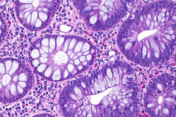 cum a ajuns cancerul de colon sa afecteze tot mai multi tineri si care este cauza principala indicata de studii 68e61cee6d9c8