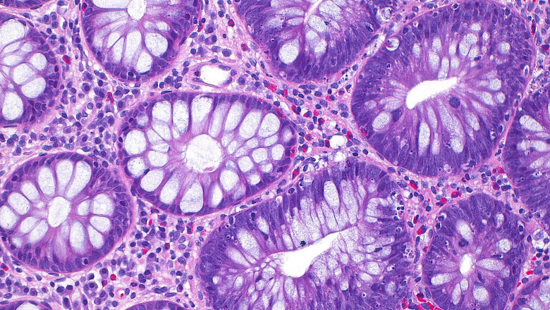 De ce cancerul de colon îngrijorează din ce în ce mai mult tinerii și care sunt factorii determinanți identificați de cercetări? 1 cum a ajuns cancerul de colon sa afecteze tot mai multi tineri si care este cauza principala indicata de studii 68e61cee6d9c8