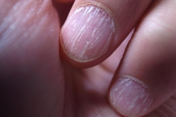 semnele de pe unghii care indica afectiunile de care suferi ce boli poti avea daca ai pete albe pe unghii 68e742db06b19