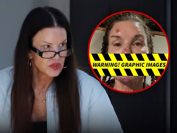 janice dickinson spotted after sharing alleged injuries from reality show fall 696c361a7ce0e